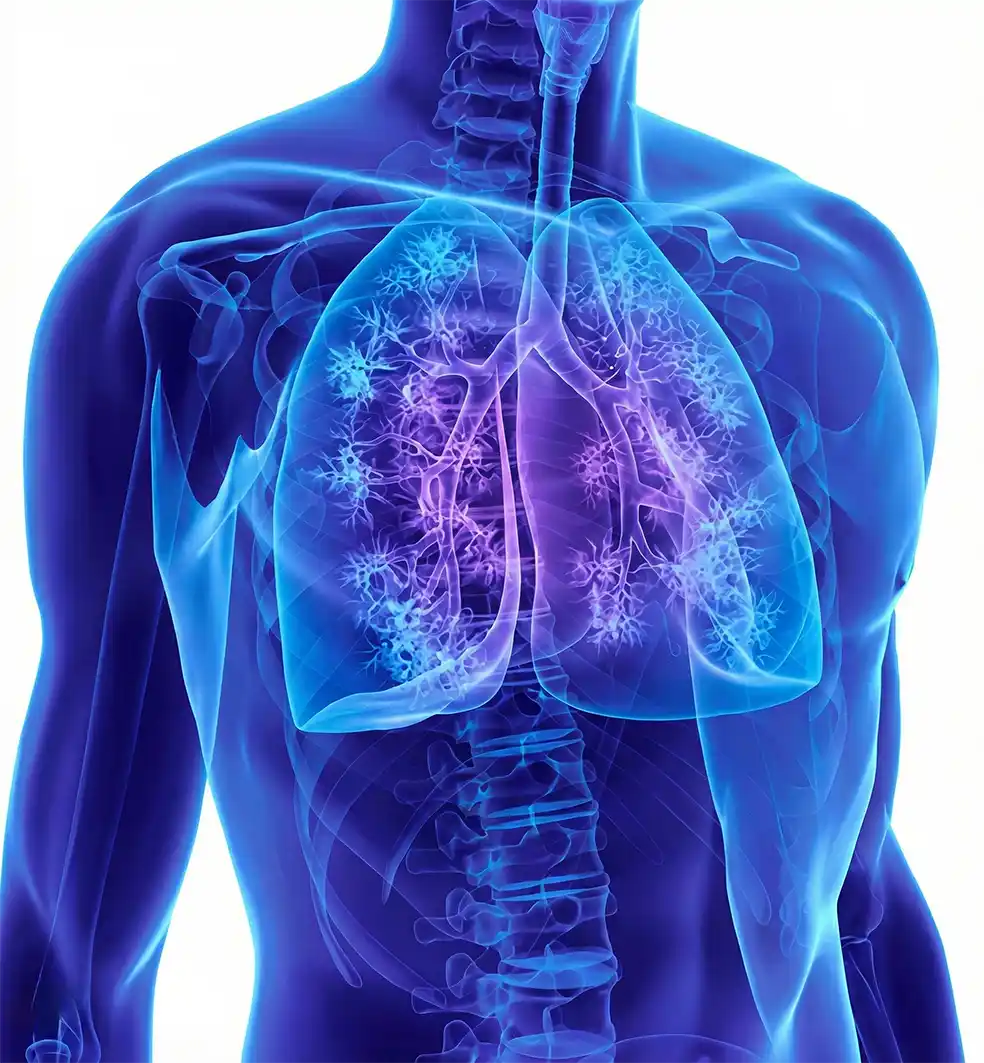 Medical illustration of human lungs affected by respirable silica dust exposure causing long-term lung disease